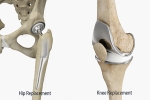 Hip and Knee Replacements – What Really Matters?