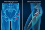 Is the 'Anterior Approach' Total Hip Replacement Better? - Tri-City  Orthopaedic Clinic